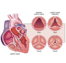 Aortic Stenosis